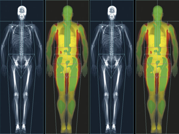BONE DENSITY | Blue Star Imaging at the Star